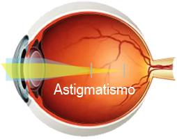 astigmatismo2