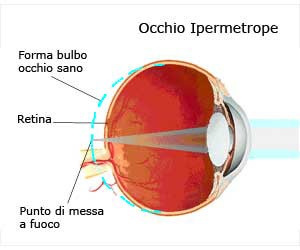 ipermetrope2