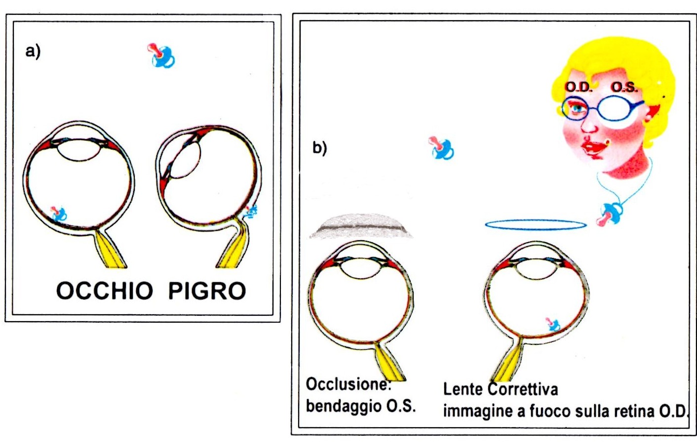 occhiopigro