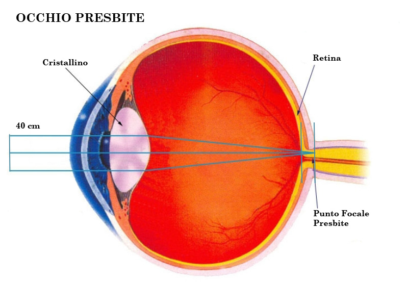 presbiopia2